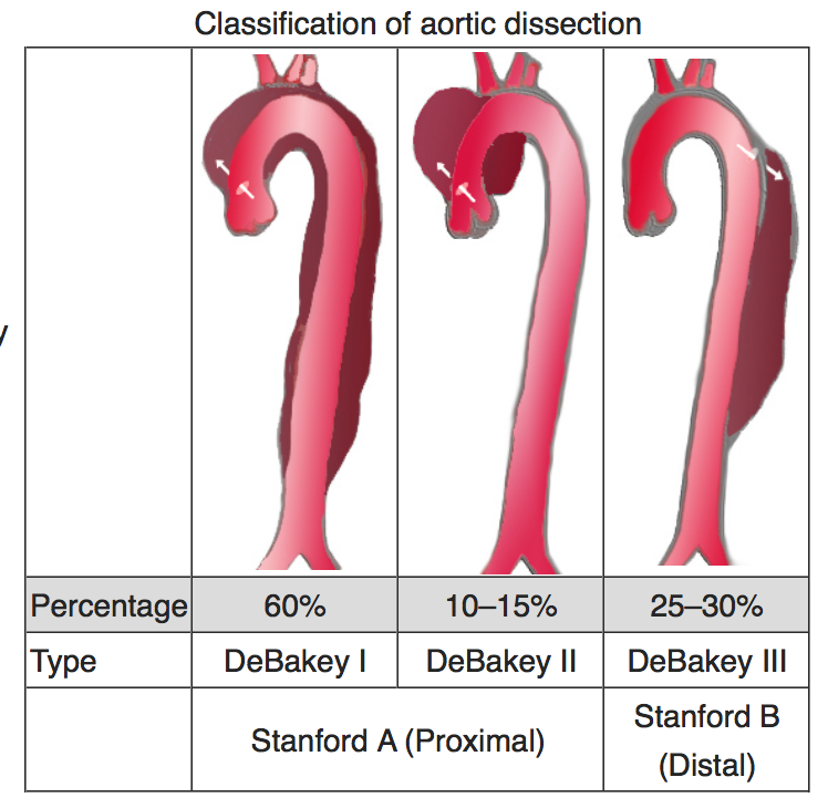 Aortic dissection. Source: Wikipedia