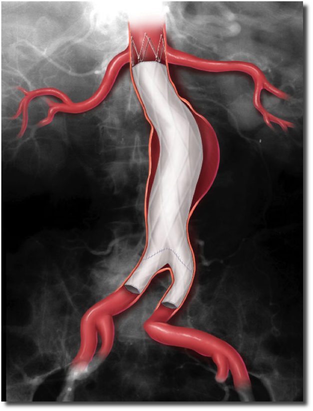 Abdominal aortic aneurysm with aortic stent
