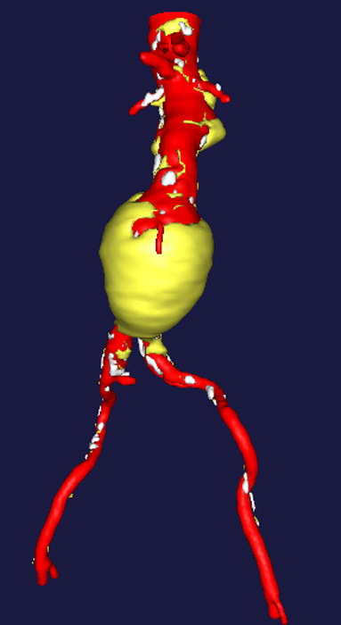 image of abdominal aortic aneurysm
