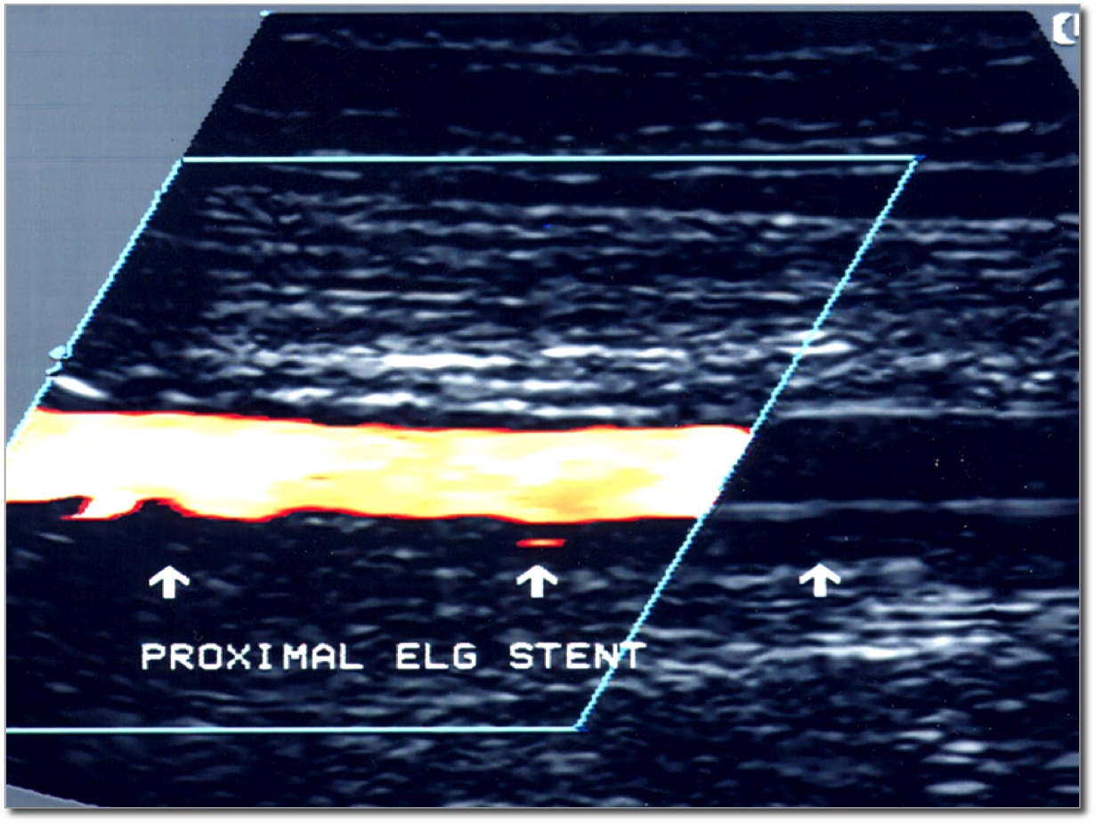 Abdominal duplex ultrasound