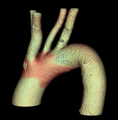 Aortic Arch with great vessels
