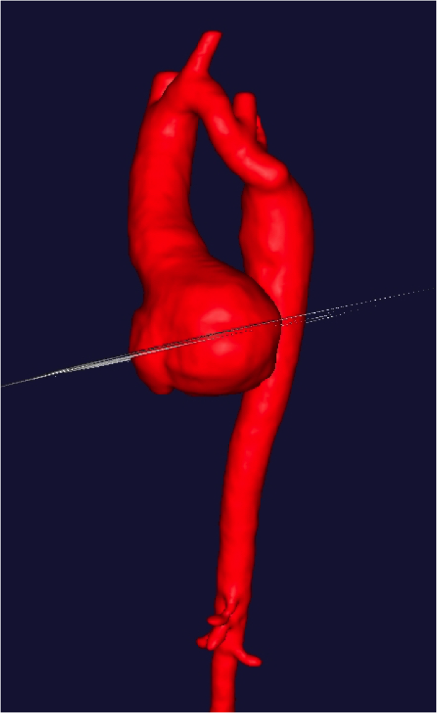 Aortic root aneurysm (6cm)