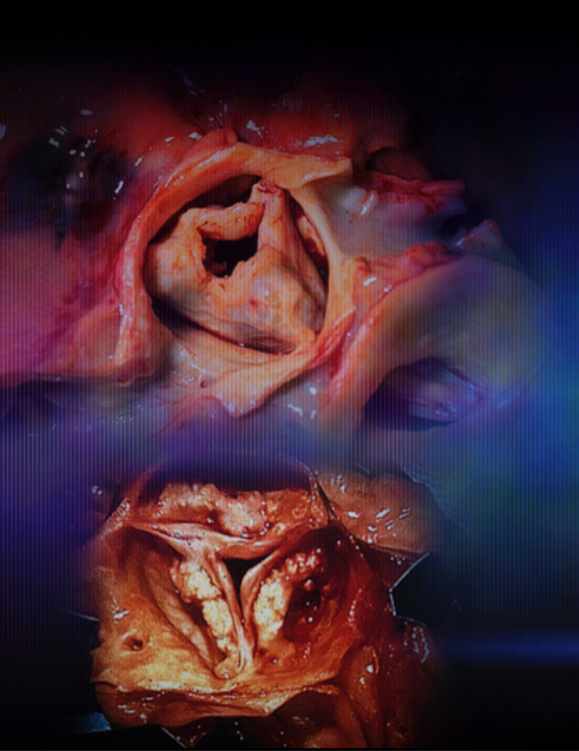 Aortic valve stenosis