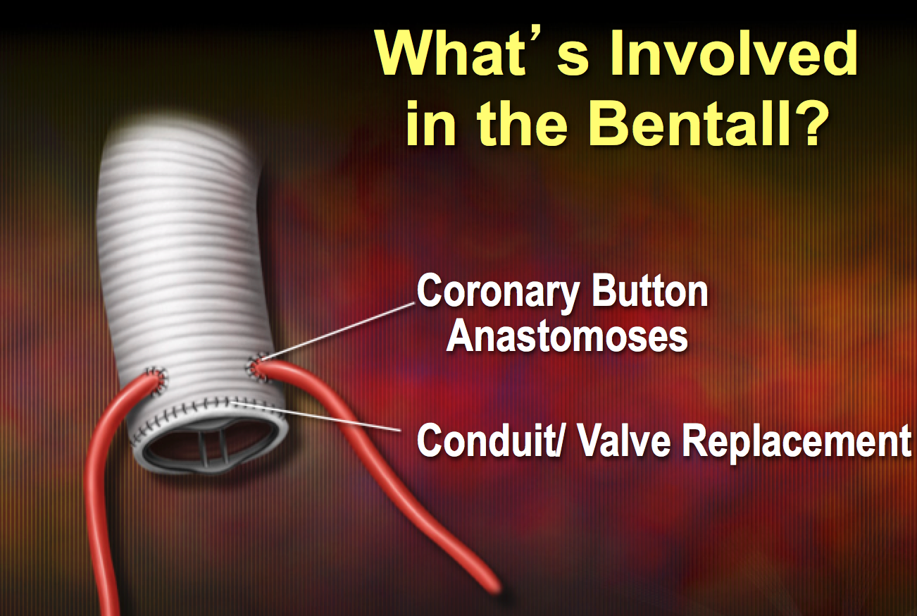 The Bentall Procedure involves replacing the aortic valve and aortic root and ascending aorta