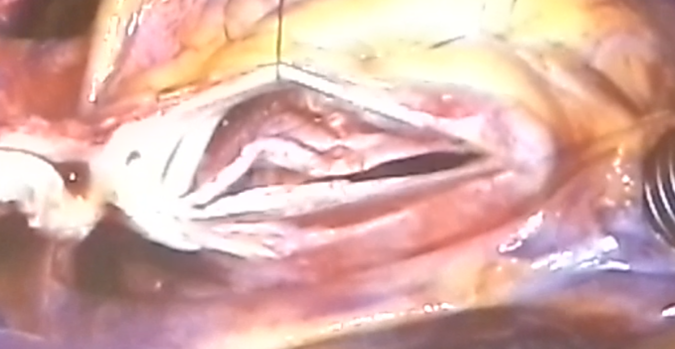 Bicuspid aortic valve (BAV) with two valve leaflets