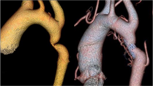 Aortic coarctation pre- and post-treatment with an endovascular stent