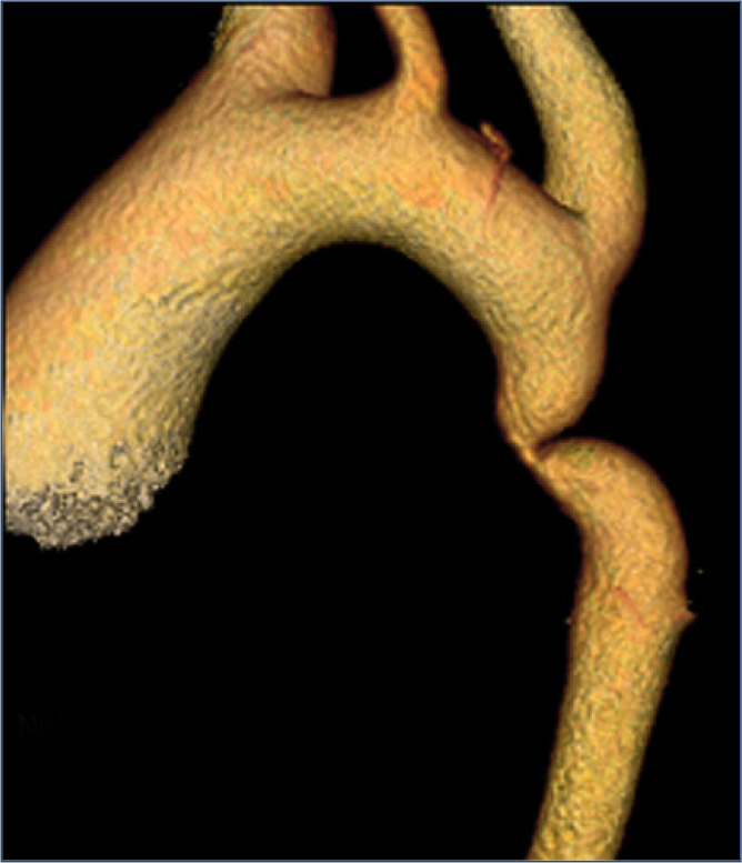 Primary adult aortic coarctation