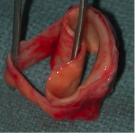 Pathologic specimen of a cross section of a dissected aorta