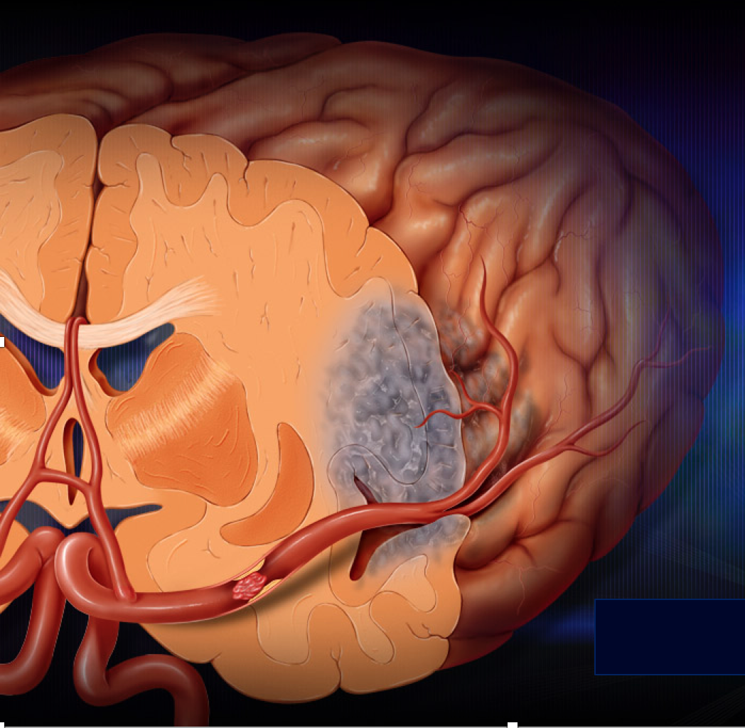 Embolic Stroke