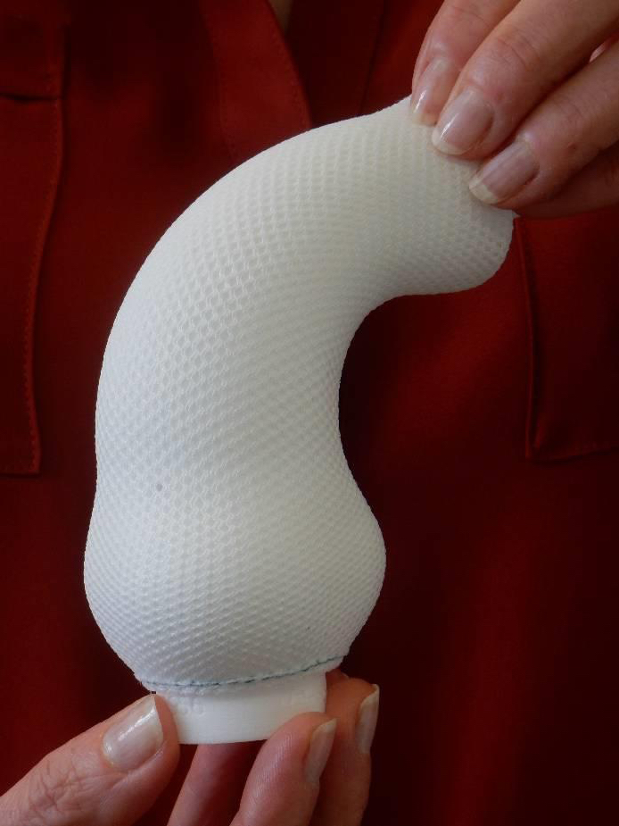 Exostent used in the PEARS Procedure for Aortic Root Dilation