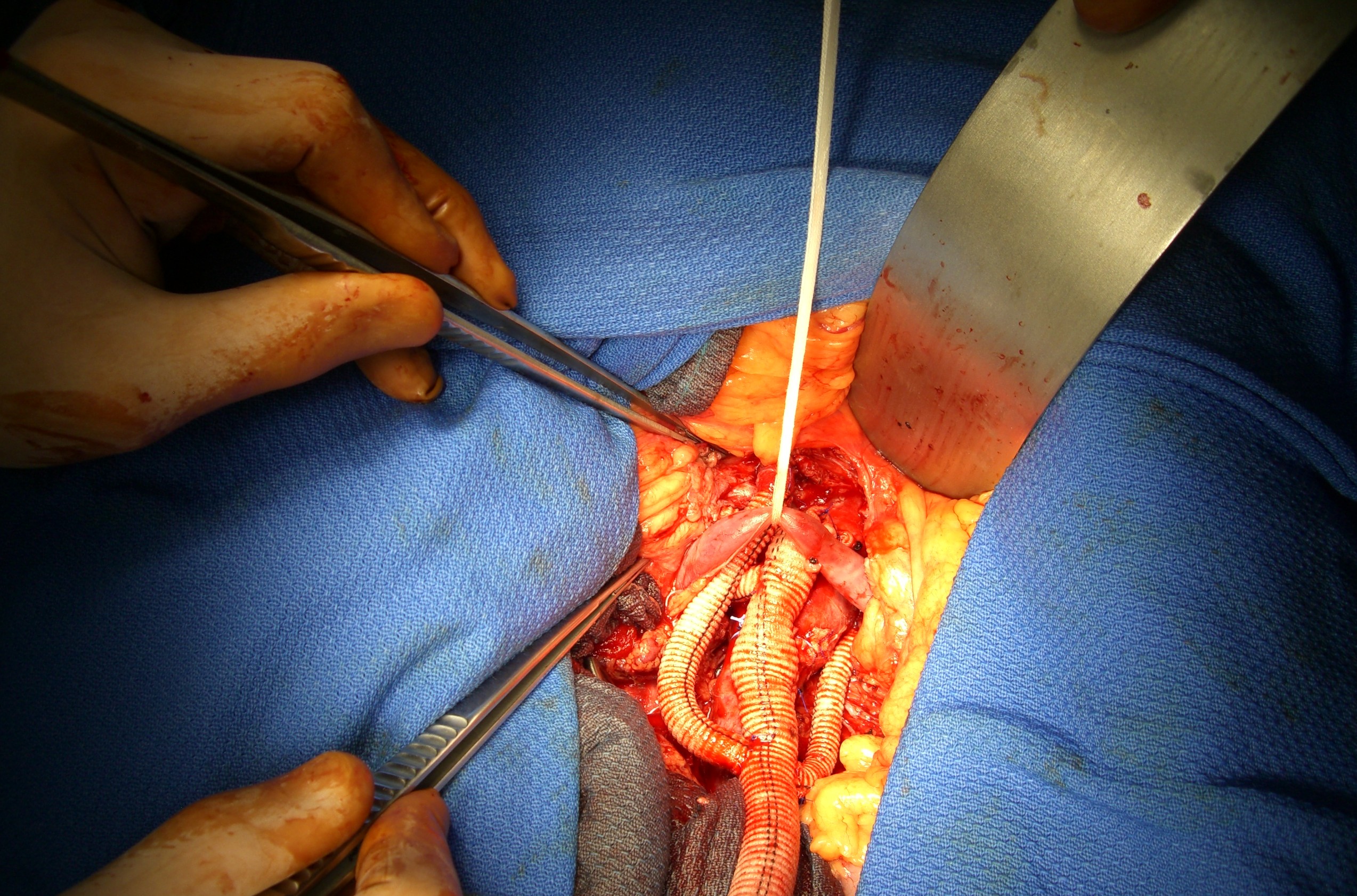 Exposure for open heart surgery
