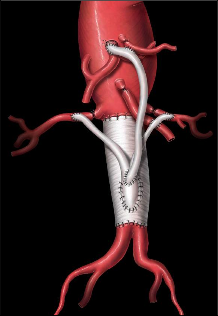 Hybrid repair of a thoracoabdominal aortic aneurysm