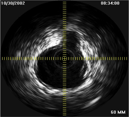 IVUS of the aorta