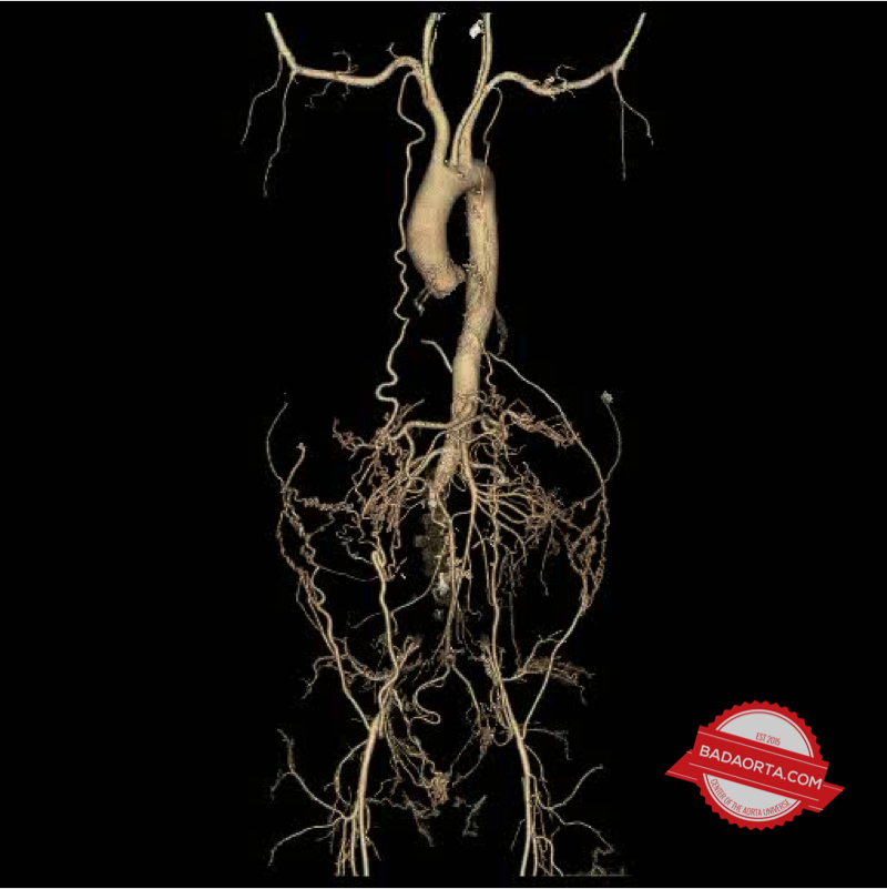 CAT scan of patient with Leriche Syndrome