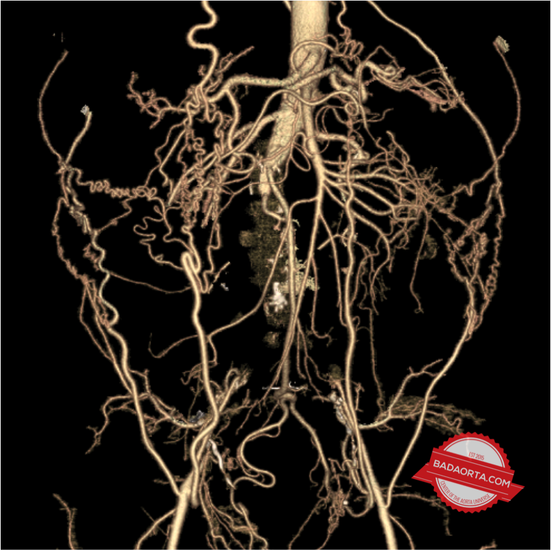 Total aorto-iliac occlusion (Leriche Syndrome)