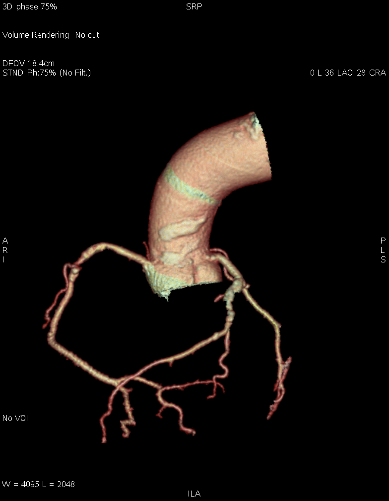 Normal aortic root