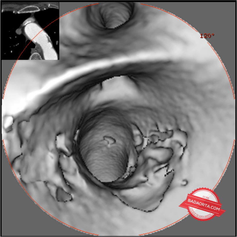 penetrating aortic ulcer