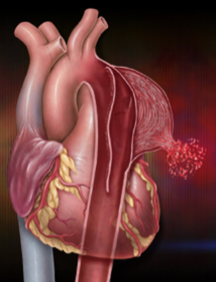 Acute aortic dissection rupture