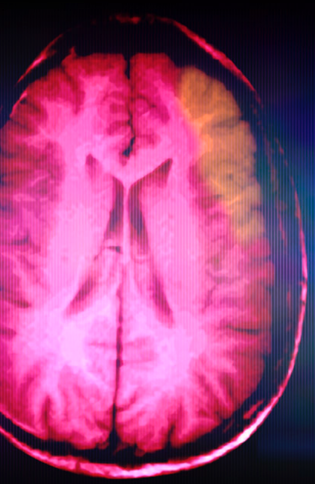 Strokes can occur after open heart surgery