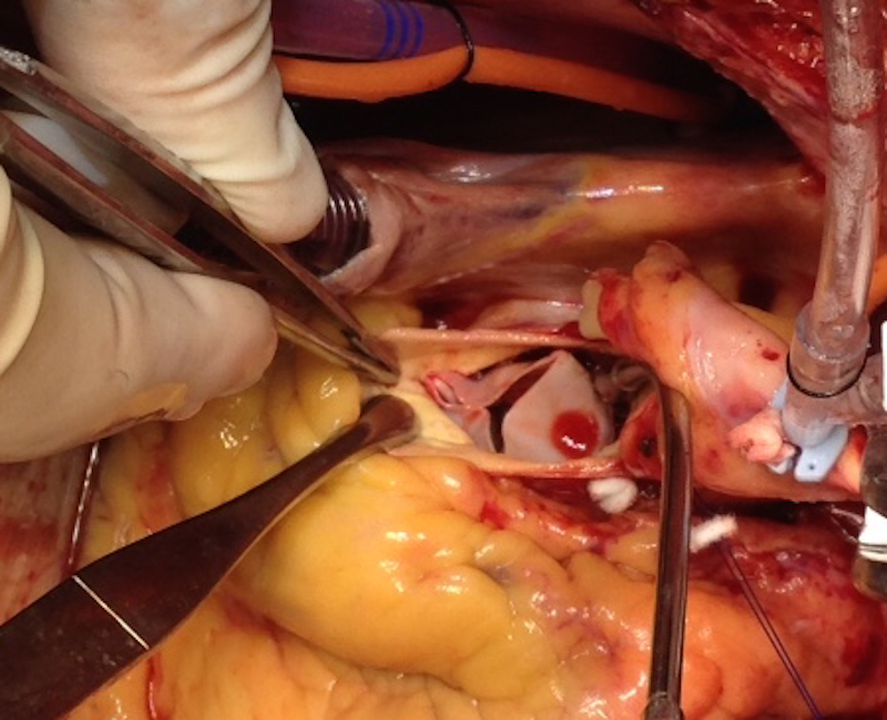 Surgical treatment of an ascending aorta with open heart surgery