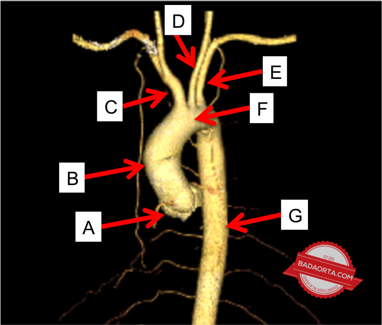 Thoracic aorta (portion of aorta located in the chest)