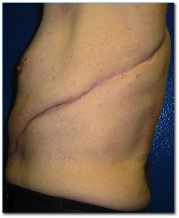 Thoracotomy incision for open surgery