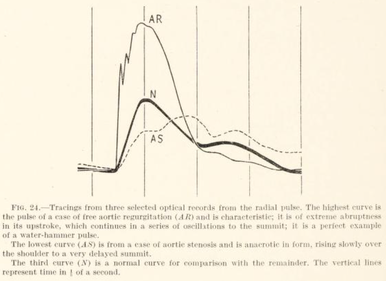 Aortic Regurgitation Aortic Regurgitation