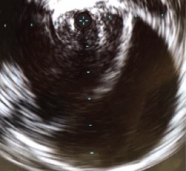 Intravascular ultrasound of an aortic dissection