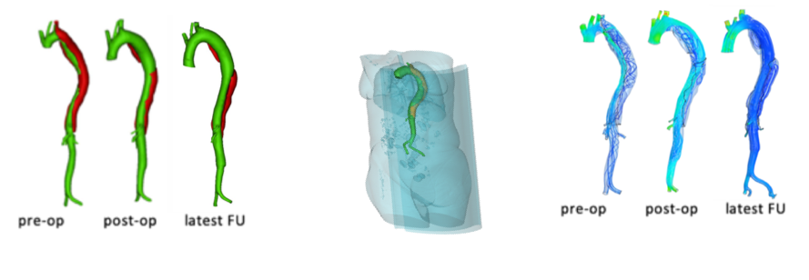 Computative Flow Dynamics of Aortic Dissections