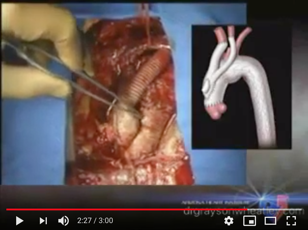 Hybrid Arch Repair Aortic Dissection Aortic Aneurysm
