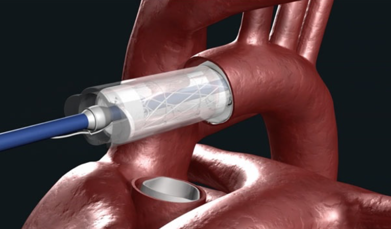 Ascyrus Medical Dissection Stent (AMDS) to treat acute Type A aortic dissections