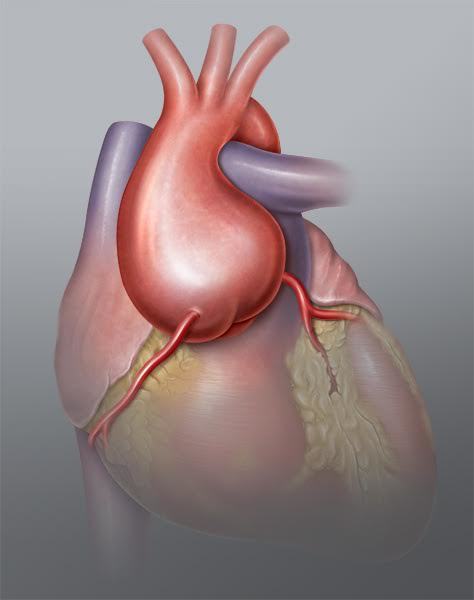 Aortic Root Aneurysm